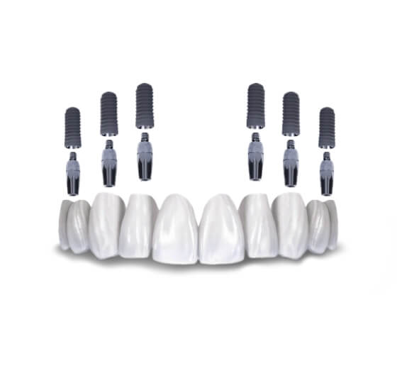 3 on 6 dental implant system