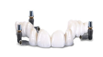 3 On 6 dental implants in cabo san lucas
