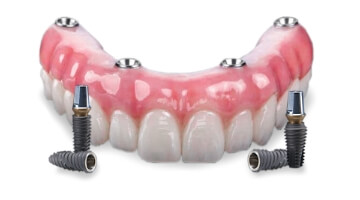 all on 4 dental prosthesis made in Advanced Cabo Dentistry