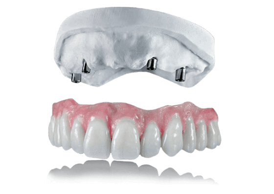All On 4 dental implants in Mexico as an alternative to 3-on-6 implants