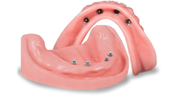 Snap-on denture retained by ball aboutments