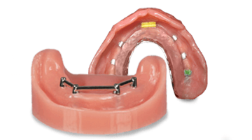 Snap on denture retaned by a titanium bar