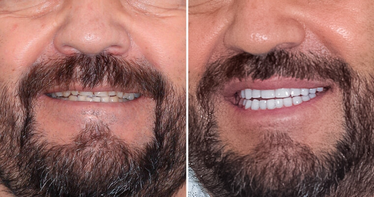 before and after pictures of dental crowns in Mexico