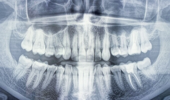 x rays of a patient in Advanced Cabo Dentistry who got porcelain crowns