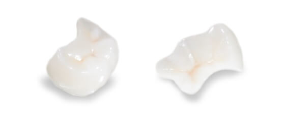 cost of dental inlays in Los Cabos Mexico