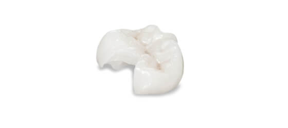 cost of dental onlays in Los Cabos Mexico
