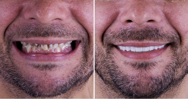 before and after pictures of several dental treatments performed by Dr. Koty