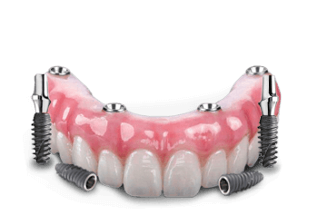 full arch dental implant prosthesis in cabo san lucas