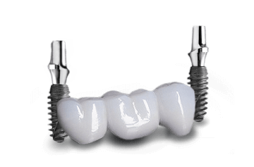 implant-supported 3 unit dental bridges in cabo san lucas