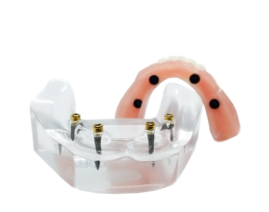 snap on overdenture with locator abutments