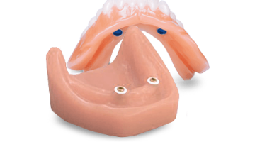 Snap on denture retained by Locator abutments