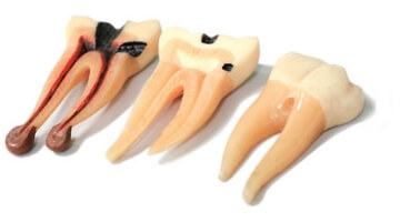 Root Canal Therapy in Cabo San Lucas