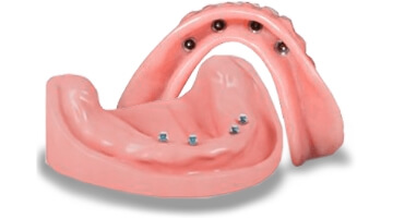 snap-on denture with mini implants made in Advanced Cabo Dentistry