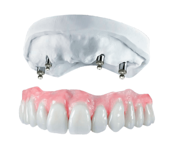 upper snap-on-denture with ball abutments and mini implants