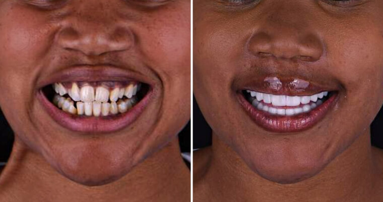 before and after for veneers in Mexico
