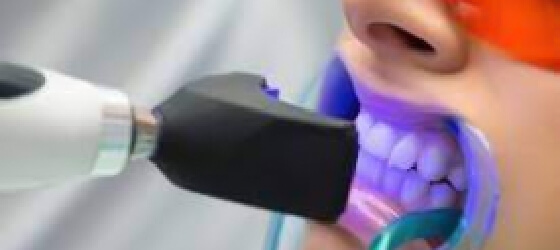 Patient at Advanced Cabo Dentistry undergoing a zoom teeth whitening treatment