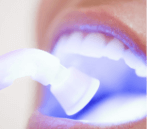 Laser teeth whitening cost in Cabo San Lucas Mexico
