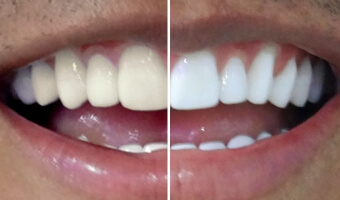 teeth whitening before and after pictures from a patient in Advanced Cabo Dentistry