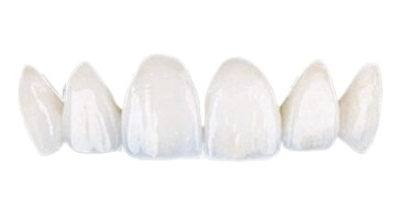 full set of emax porcelain veneers in Cabo San Lucas