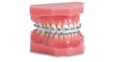 Orthodontic braces in Cabo San Lucas