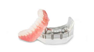 cost of snap on dentures in Mexico with 4 regular dental implants