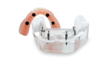 cost of snap on dentures in Mexico with 4 mini dental implants