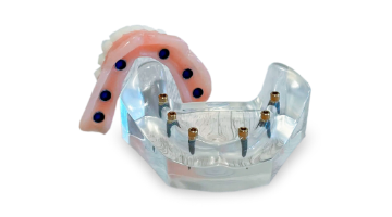 cost of snap on dentures in Mexico with 6 regular dental implants