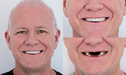 Patient who got affordable dental implants in Cabo san Lucas