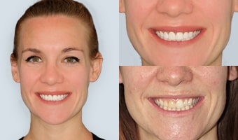 Advanced Cabo Dentistry patient Porcelain eneers