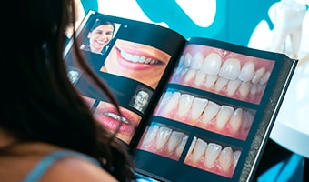 Best dentist for Veneers in Mexico