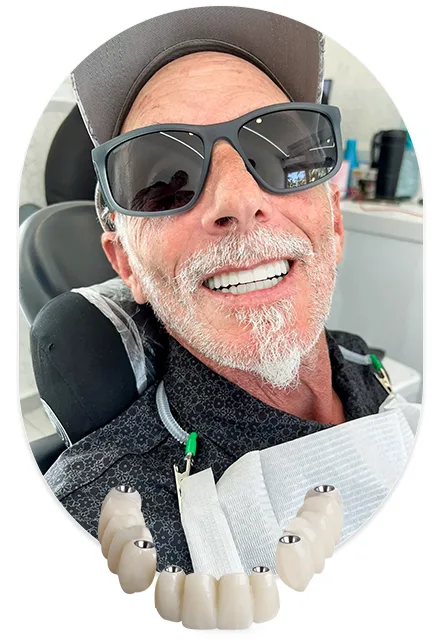 3-on-6 Dental Implants in Mexico performed at Forever Clinic in San Miguel de Allende