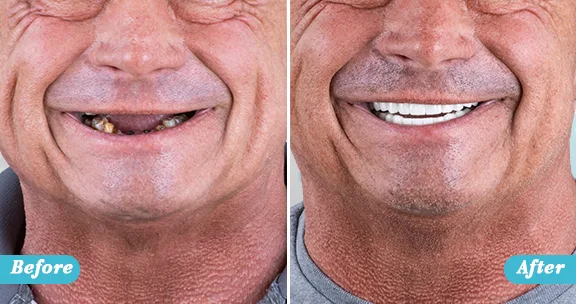 3-on-6 Implant Bridges before and after Full Mouth Implants at Forever Clinic in San Miguel de Allende