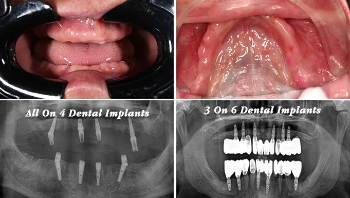 All-on-4 vs 3-on-6 Dental Implants comparison at Forever Clinic in San Miguel de Allende.
