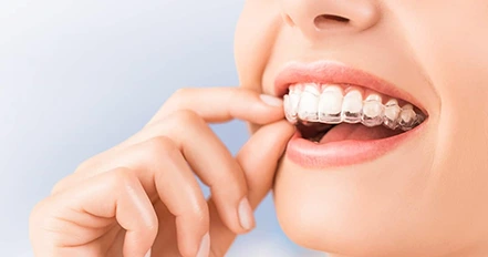 How long Invisalign treatment takes at Advanced Cabo Dentistry, Los Cabos