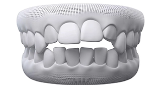 Invisalign treatment for Open Bite at Advanced Cabo Dentistry, Los Cabos