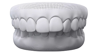 Invisalign solution for Overbite at Advanced Cabo Dentistry, Los Cabos