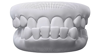 Invisalign correction for Underbite at Advanced Cabo Dentistry, Los Cabos