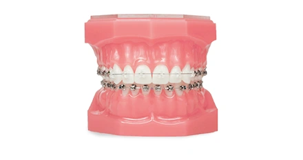 Damon Braces option at Advanced Cabo Dentistry, Los Cabos orthodontics