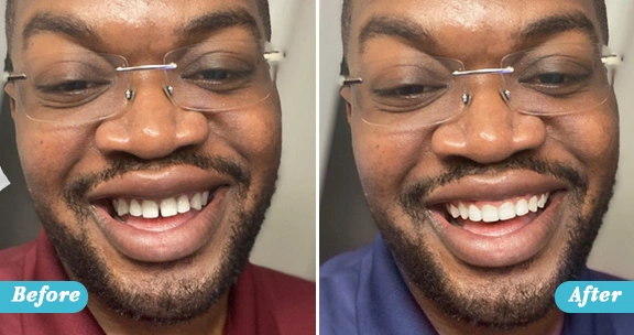 Before and After Braces results at Advanced Cabo Dentistry, Los Cabos orthodontics