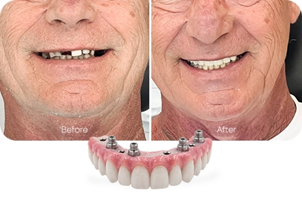All-on-4 fixed hybrid bridge dental implants before and after in Los Cabos, Mexico