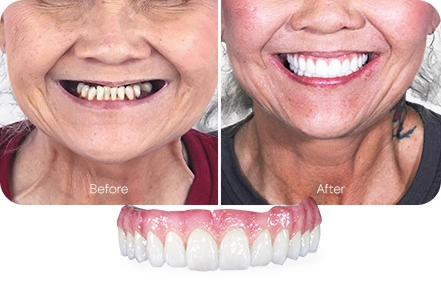 Nano-ceramic hybrid all-on-4 dental implants before and after in Los Cabos