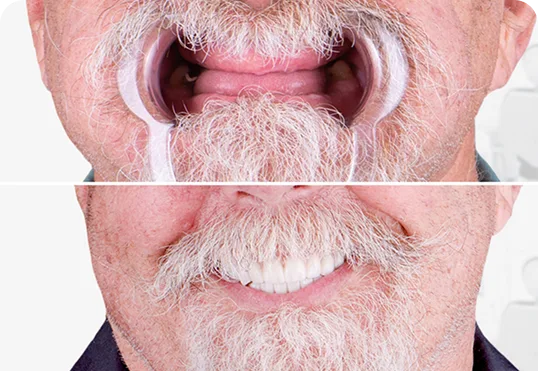 Before and after, dental result for All On 4 Implants