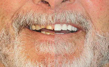 Before and after smile transformation showing restored upper teeth on elder man.