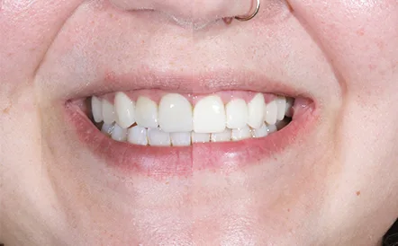 Before and after smile transformation with brighter, straighter teeth.