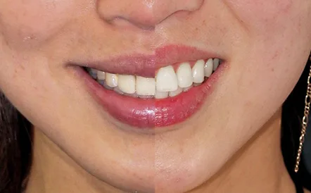 Before and after cosmetic smile makeover with natural-looking veneers.