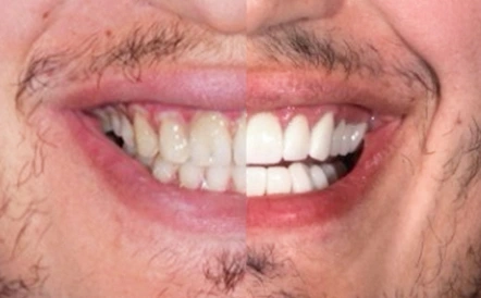 Comparison of smile transformation showing improved tooth alignment and color.