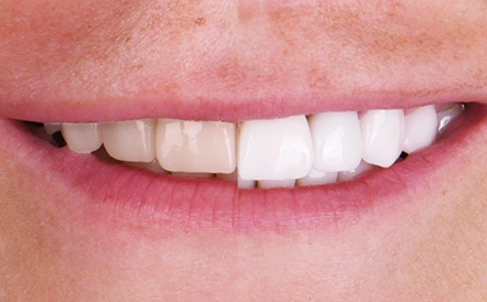 Before and after smile makeover with whiter, more even front teeth.