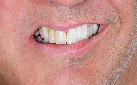 Before and after photos of dental smile restoration with whiter tooth appearance.