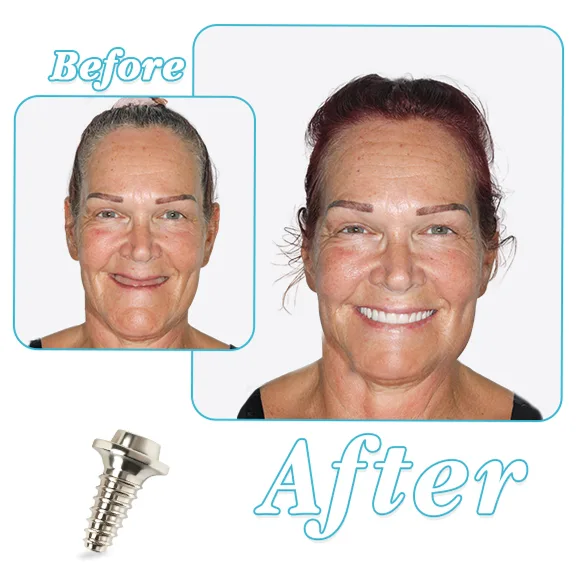 Before and after full mouth dental implant treatment showing smile restoration photo comparison.