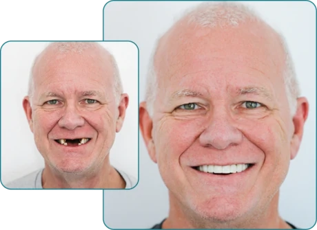 Modern dental implants in Cabo San Lucas